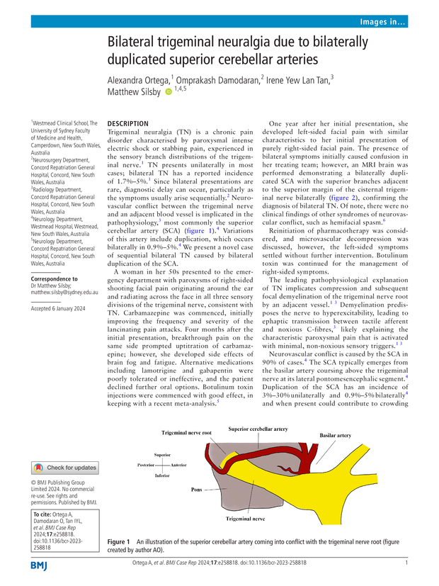 Bilateral trigeminal neuralgia due to bilaterally duplicated superior ...