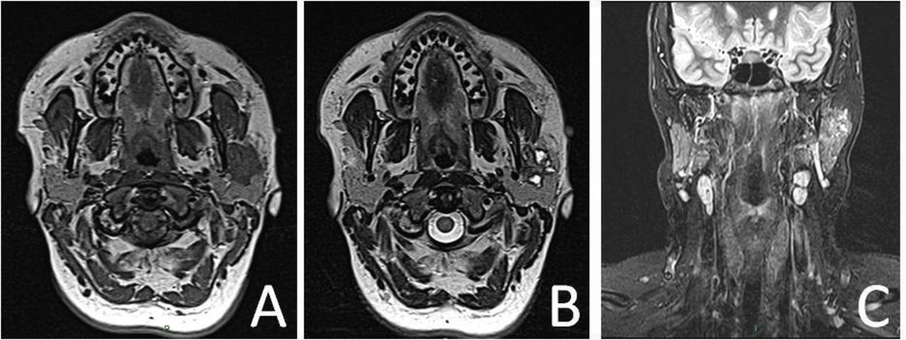 Mucoepidermoid Carcinoma Of Parotid Gland