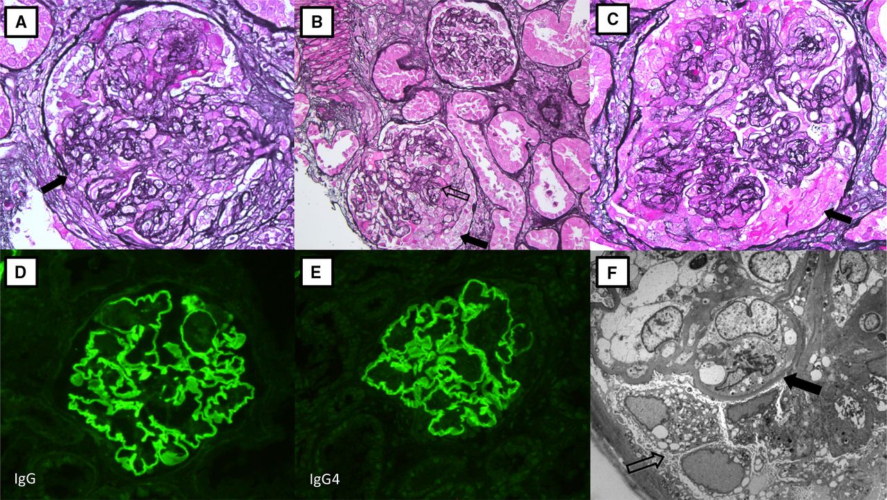 Antiglomerular basement membrane (anti-GBM) disease with clinical and ...