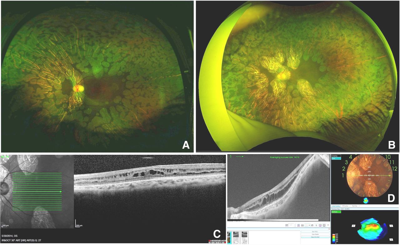 Ultrawide field imaging to document the progression of gyrate atrophy ...