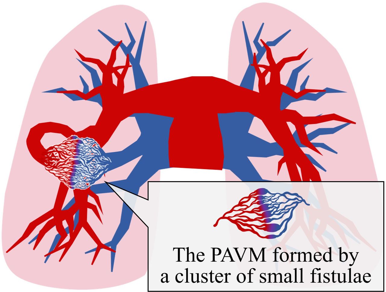 Evaluation of a gradually enlarging complex pulmonary arteriovenous