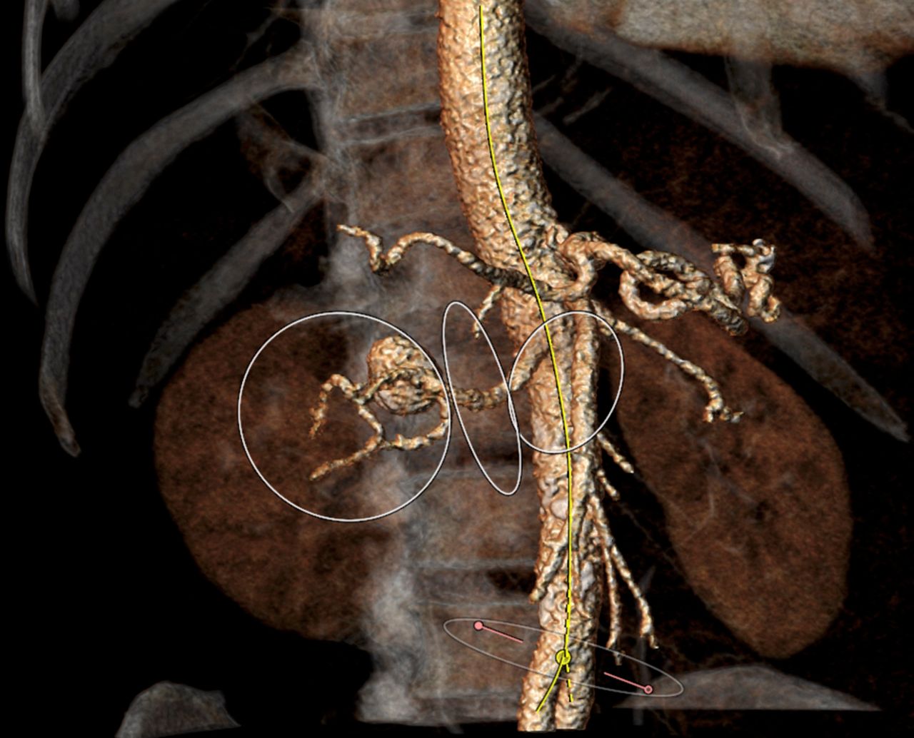 Management of complex symptomatic renal artery aneurysm in a patient ...