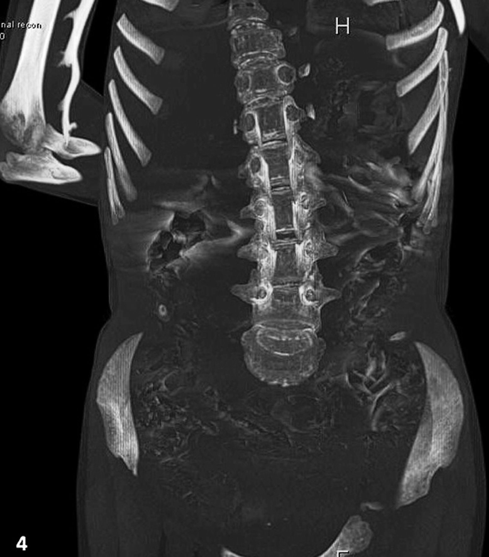 stone-man-disease-symptoms